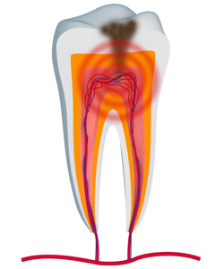 root canal for tooth pain relief from a dentist in Arlington TX