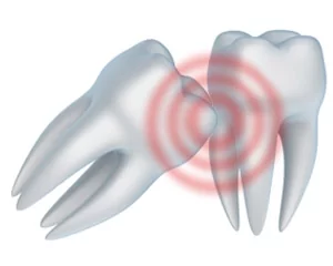 Diagram showing the problems that can arise if a wisdom tooth extraction does not take place.