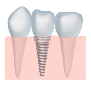 Cosmetic Dentistry Teeth in Gums - Stephen Ratcliff Arlington TX Dentist