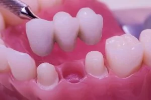 Dental Bridge for Teeth - Stephen Ratcliff Arlington TX