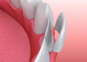 Porcelain Dental Veneers Illustration - Dr. Stephen Ratcliff Family and Cosmetic Dentistry Arlington TX