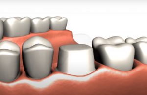 Dental Crown Tooth Preparation - Stephen Ratcliff Family & Cosmetic Dentistry Arlington TX