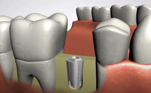 Dental Implant Placement in Jaw Bone - Stephen Ratcliff Family & Cosmetic Dentistry Arlington TX