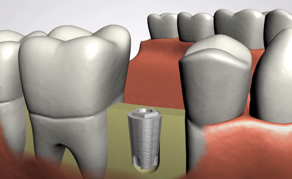 Dental Implants Arlington TX Tooth Replacement Stephen Ratcliff