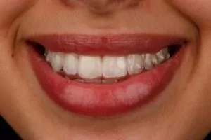 ClearCorrect invisible braces Arlington TX