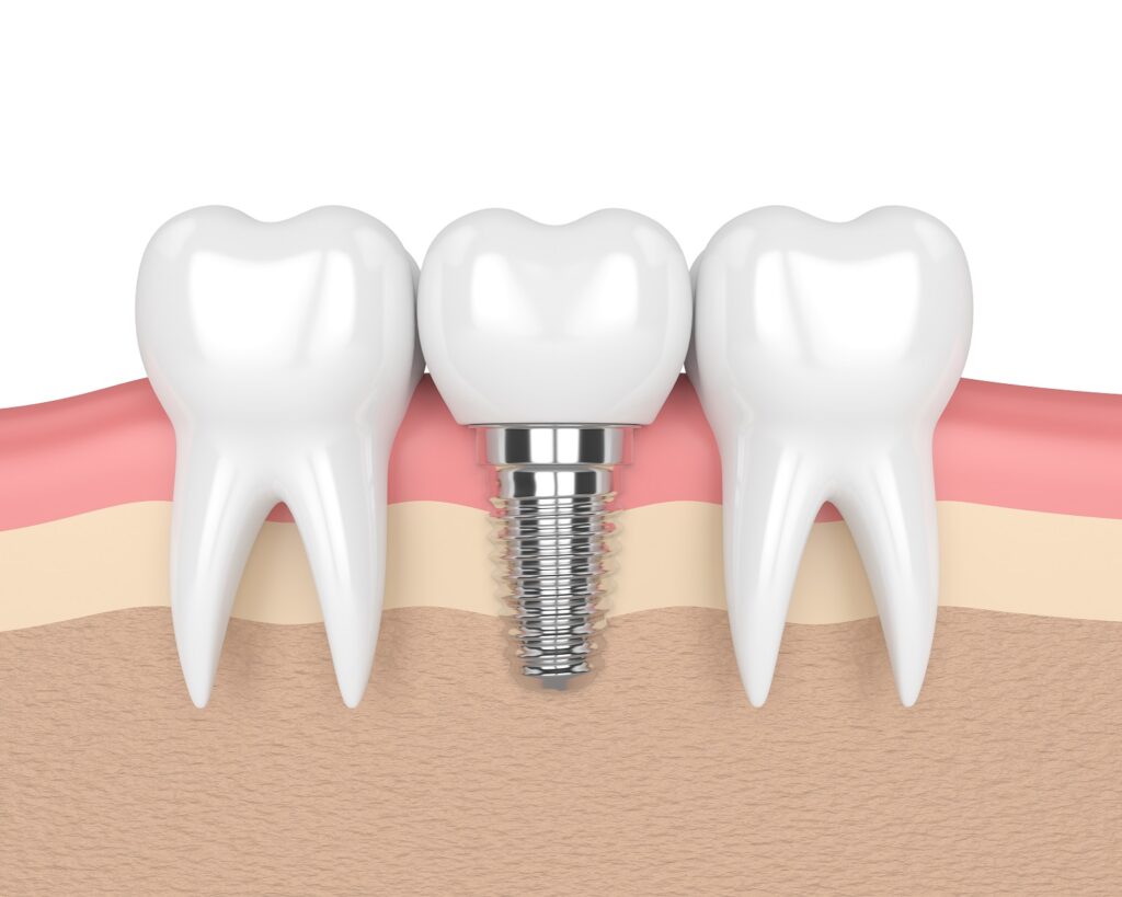 Dental Implants Arlington TX Tooth Replacement Stephen Ratcliff