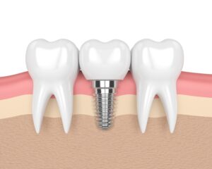 Dental Implants Cost - Stephen Ratcliff Family and Cosmetic dentistry Arlington TX