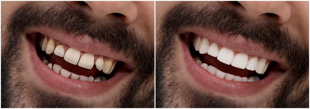 Before and after porcelain dental veneers