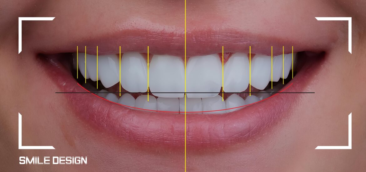 smile design treatment, beautiful smile using computer-aided dental design programs