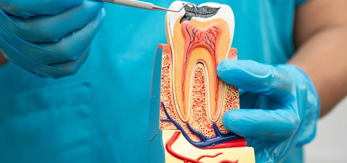 doctor in blue gloves holding model tooth, showing exposed pulp, need for root canal