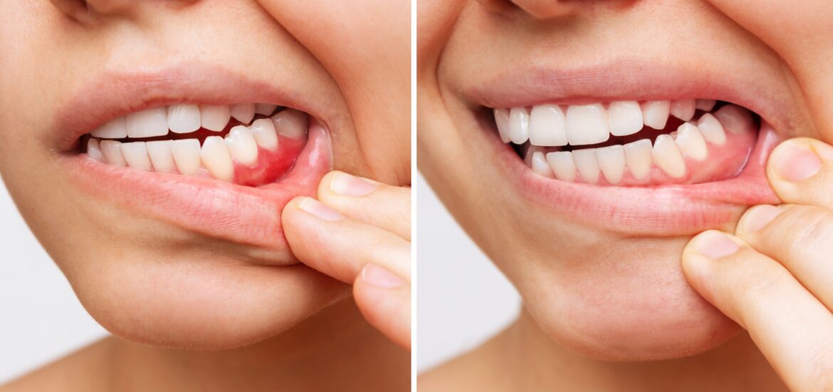 side by side closeup of gum disease progression