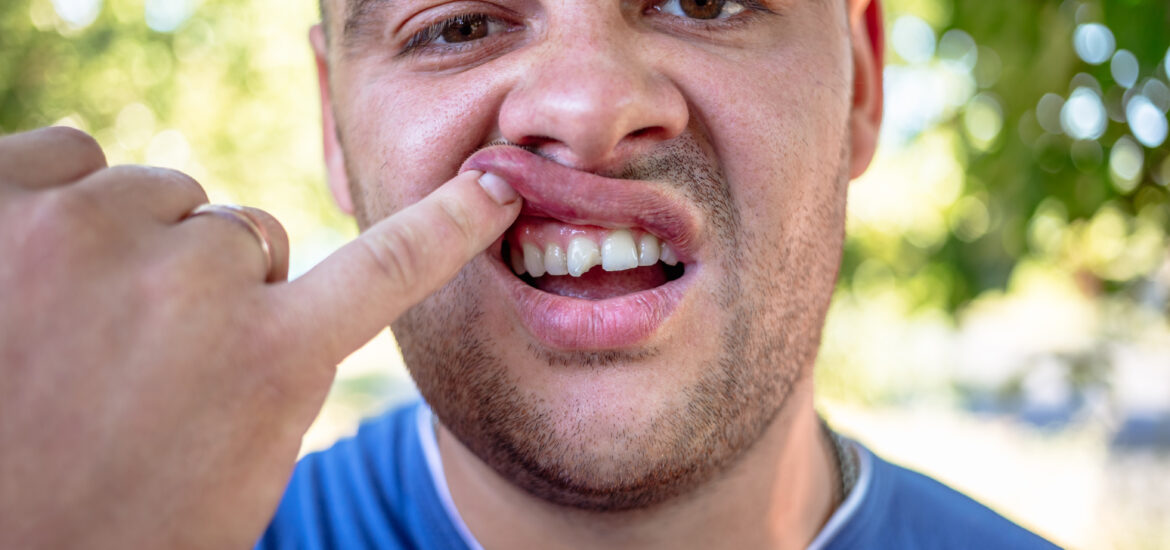 man in a blue shirt exposing a chipped tooth